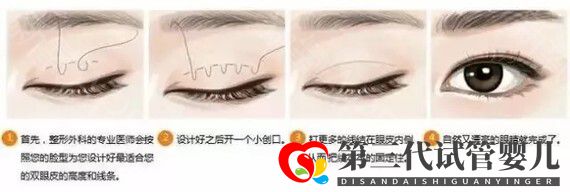 埋線雙眼皮恢復(fù)期要多少時(shí)間？(圖1)