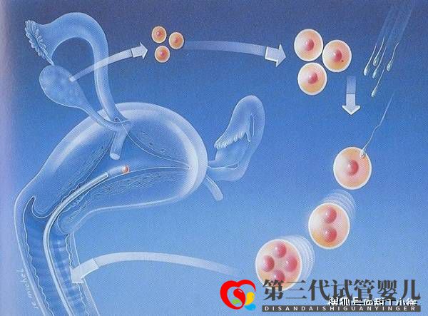 影響試管嬰兒價格的因素有哪些(圖1)