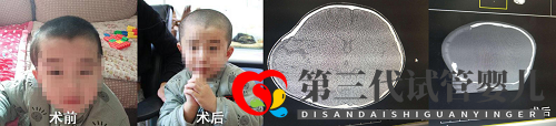 合肥哪家醫(yī)院可以做顱骨修補術(圖1) 合肥哪家醫(yī)院可以做顱骨修補術(圖1)
