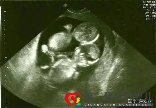 多年不孕,深圳三代試管一次成功雙胎男寶(圖5)