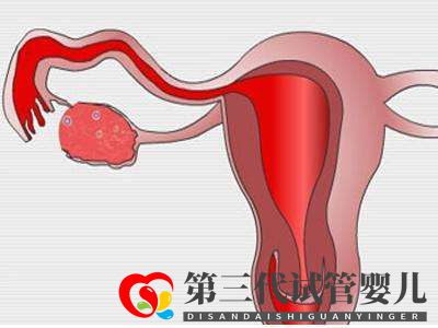 子宮肌瘤做俄羅斯試管嬰兒的成功率高嗎？(圖1)