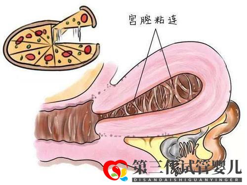 子宮粘連可以做試管嬰兒?jiǎn)?？成功率高不高?圖2)
