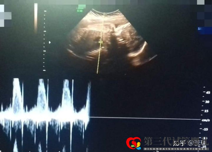我終于懷上了!辛酸三代試管經(jīng)歷!大家接好孕!(圖3) 我終于懷上了!辛酸三代試管經(jīng)歷!大家接好孕!(圖3)