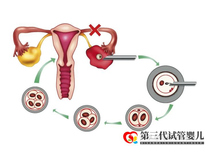 試管嬰兒1代、2代、3代、4代哪個最好真實(shí)操作過...(圖8)