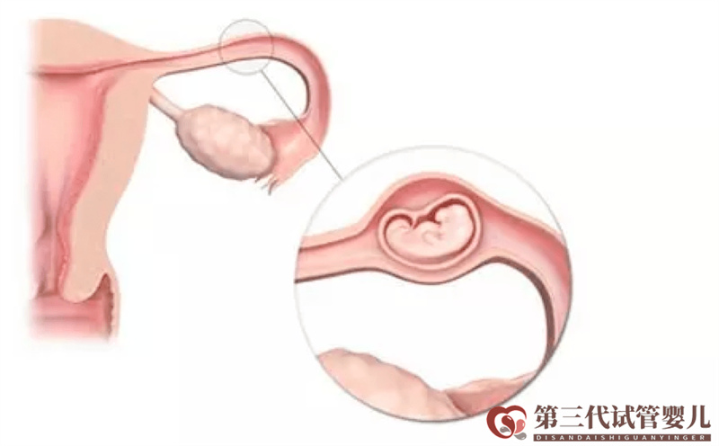 做試管嬰兒是不是可以避免宮外孕了？醫(yī)生告訴你沒那么簡單！(圖1)