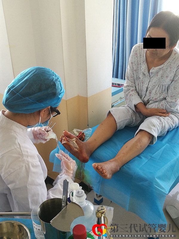 糖尿病并發(fā)癥糖尿病足到底有多可怕，可以避免截肢嗎？(圖2)