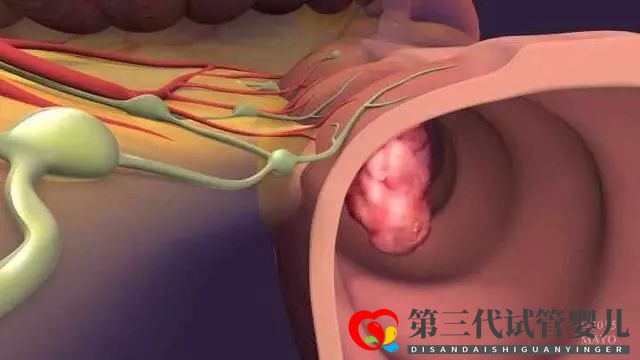 研究：基因操縱結(jié)腸癌細(xì)胞中的蛋白質(zhì)水平可以改善化療情況(圖3)