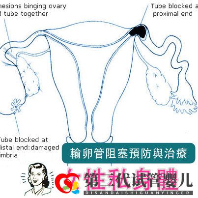 輸卵管堵塞,懷孕到底有多難(圖2)