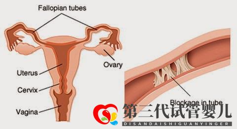 輸卵管堵塞,懷孕到底有多難(圖3)