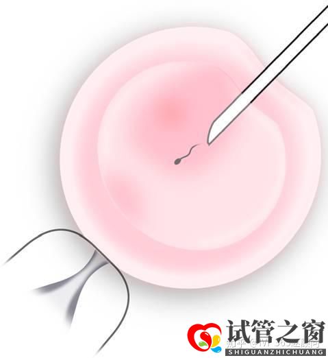 關于試管嬰兒,你想知道的都在這里,不懂就得多看看(圖2) 關于試管嬰兒,你想知道的都在這里,不懂就得多看看(圖2)