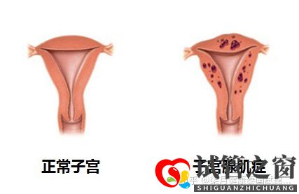 33歲子宮畸形多年未孕,如何提高試管成功率(圖2) 33歲子宮畸形多年未孕,如何提高試管成功率(圖2)