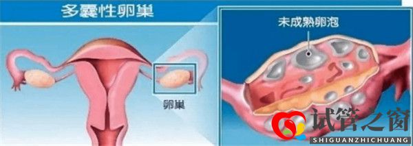 多囊卵巢綜合征對試管嬰兒成功率有哪些影響如何及時(shí)調(diào)理(圖1)