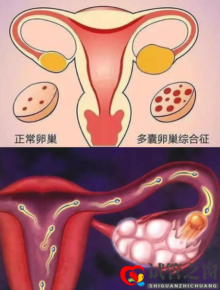 多囊卵巢綜合癥做試管嬰兒要注意什么(圖1)