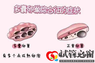 多囊做試管嬰兒要注意什么(圖2)