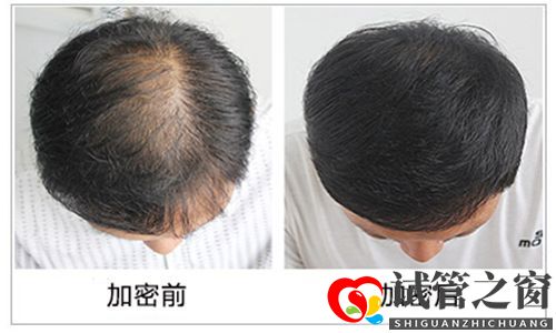哈爾濱做頭發(fā)加密有年齡要求嗎？(試管嬰兒成功率)(圖1)