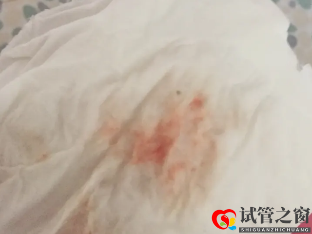 取卵后出現(xiàn)少量出血為正?，F(xiàn)象