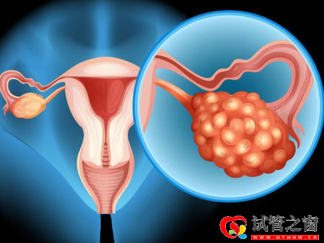 多囊可以進(jìn)行治療懷孕