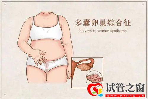 如何降低多囊卵巢的風(fēng)險(xiǎn)(圖1)