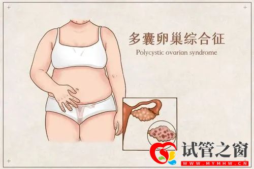 如何防止多囊卵巢復(fù)發(fā)？(圖1)
