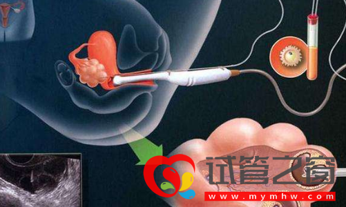 試管取卵手術(shù)示意圖