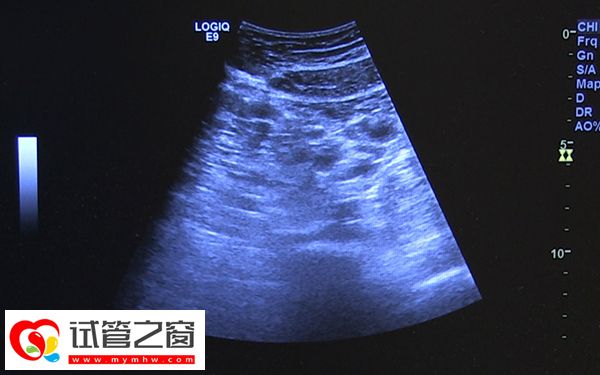 促排卵后出現(xiàn)5個成熟卵泡是正常的