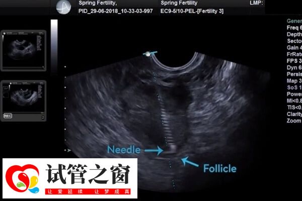 取卵后腹水要注意及時(shí)就醫(yī)