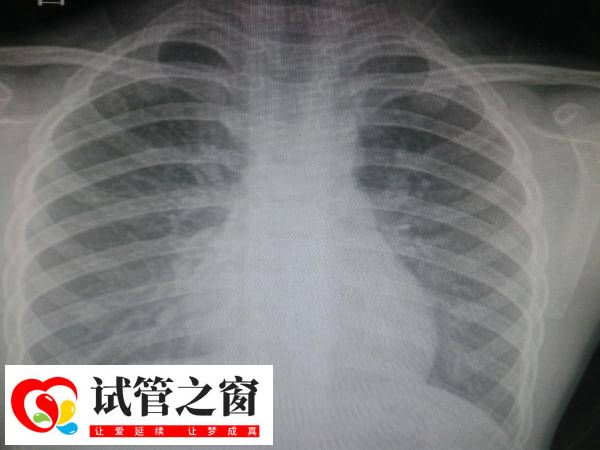 做試管拍胸片是常規(guī)體檢項目之一