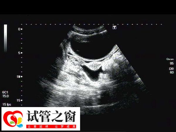 囊胚移植后會(huì)開(kāi)始在子宮內(nèi)漂浮