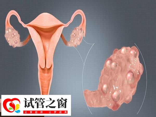 輸卵管存在炎癥大部分會有積水