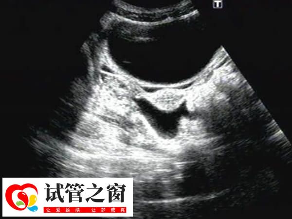 盆腔積液是女性生殖系統(tǒng)的常見癥狀表現(xiàn)